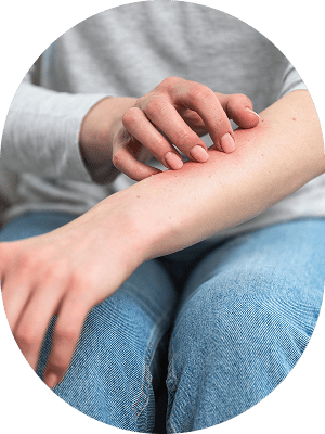 アトピー性皮膚炎